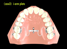 斉宮康寛さん考案の、新技術によるインプラント歯科矯正